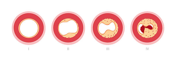 atherotrombosis w naczyniach - human artery cholesterol atherosclerosis human heart stock illustrations