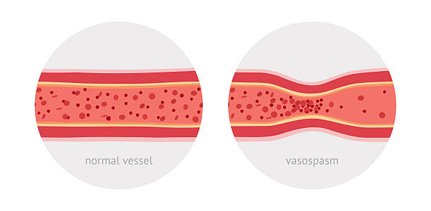 Healthy and sick human vessels Healthy and sick spasm anatomical vessels with blood cells vector illustration blood vessel stock illustrations