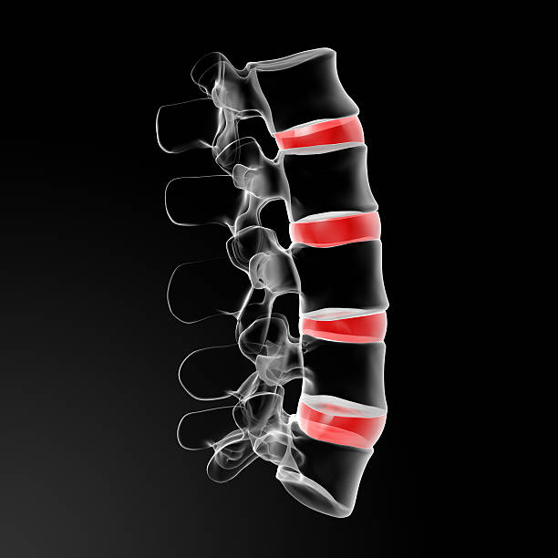 Compressive Discopathy 20+ Discopathy Stock Photos, Pictures & Royalty-Free Images - iStock