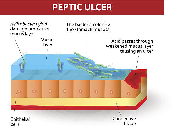 ilustraciones, imágenes clip art, dibujos animados e iconos de stock de helicobacter pylori y úlceras de la enfermedad - pylori