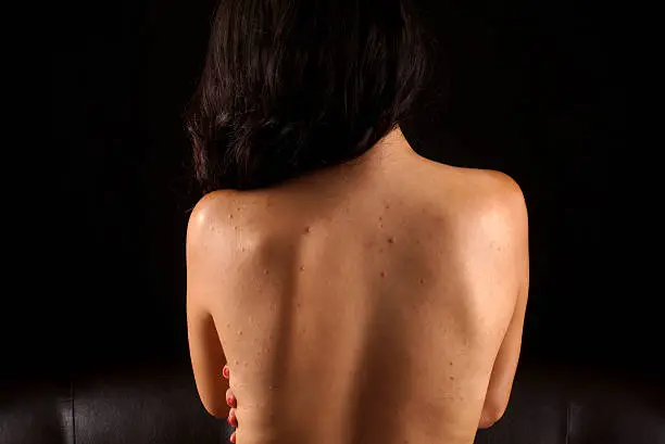 Photo of acne on a females back