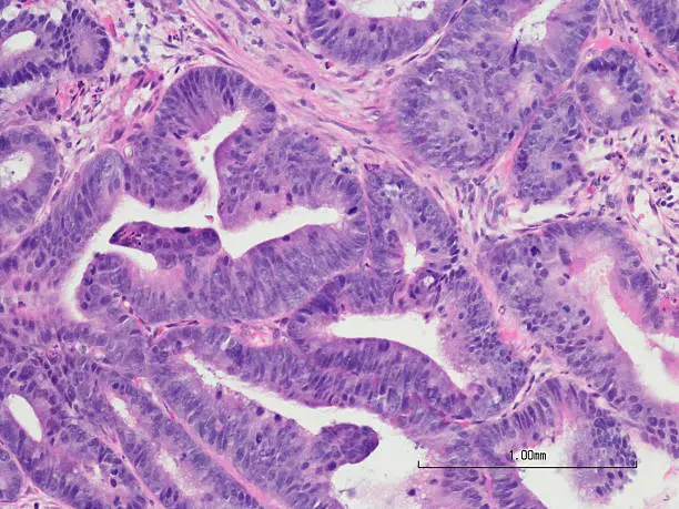 Photo of Colonic adenocarcinoma with H&E Staining