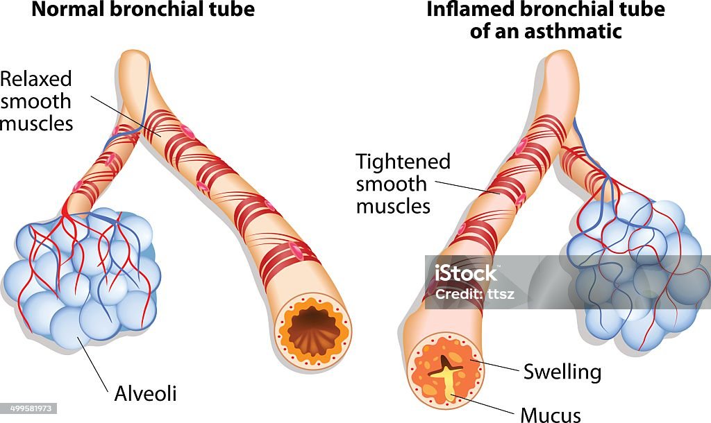inflamation of the bronchus causing asthma Asthma is a chronic inflammatory disease of the airways that is characterized by narrowing of the airways and dyspnea, wheezing, and coughing. Asthmatic stock vector