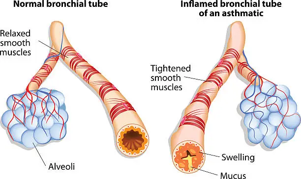 Vector illustration of inflamation of the bronchus causing asthma