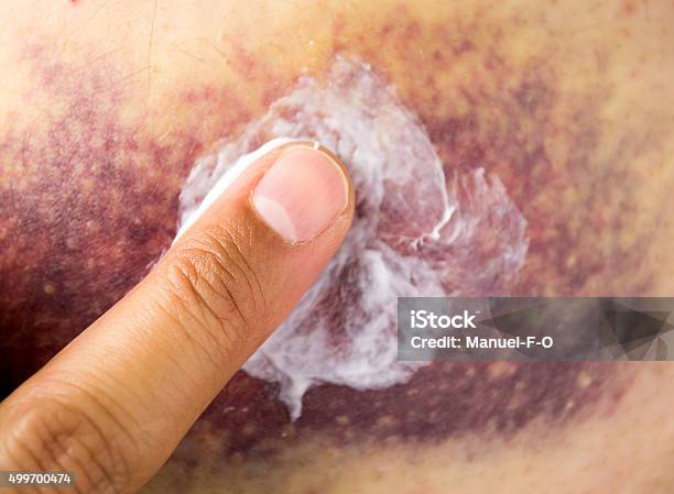 Putting Ointment On The Bruise Stock Photo - Download Image Now - Bruise, Hemorrhage, Adult