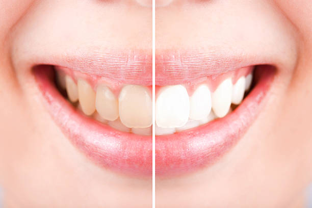 istock Close-up teeth female between before and after brush the teeth, 499780106