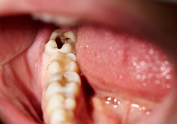 損傷トゥース空洞付き歯科 caries ディケイ - 歯垢 ストックフォトと画像