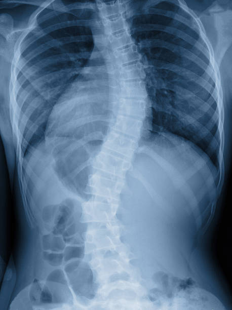 scoliose film x-ray afficher la colonne vertébrale au patient bend adolescente - scoliosis photos et images de collection