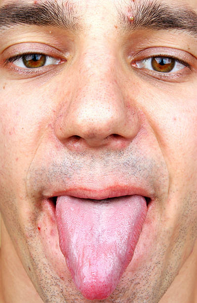 istock Infection tongue and acne 500078006
