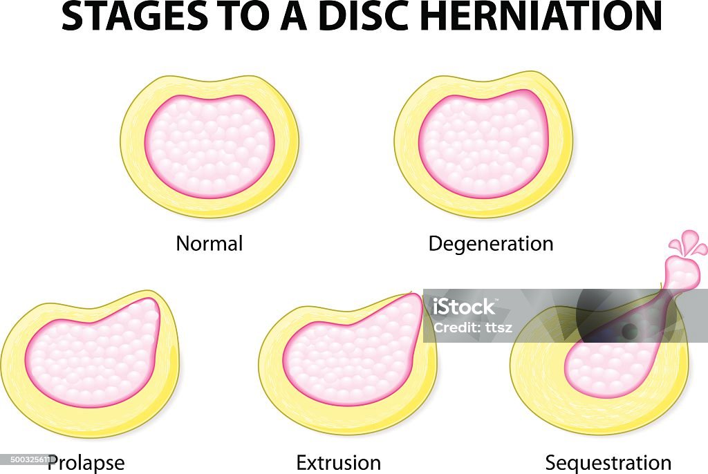 stages to a disc herniation stages to a disc herniation. Normal, Degeneration, Prolapse, Extrusion, Sequestration Aging Process stock vector