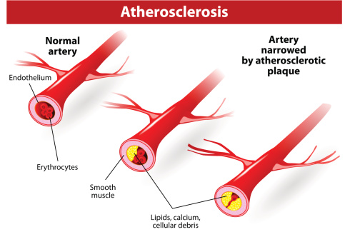 Illustrates The Progression Of Atherosclerosis In Cvd Patients Stock  Illustration - Download Image Now - iStock