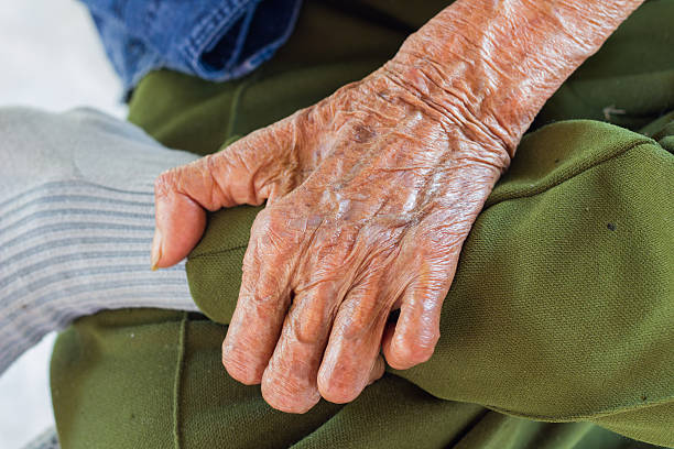 istock left hand of a leprosy 500388047
