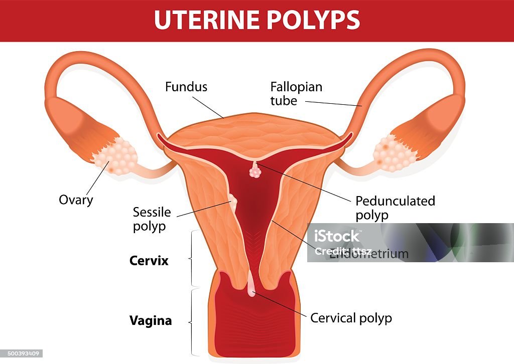 Endometrial polyp ou polyp utérine - clipart vectoriel de Polype - Tumeur libre de droits