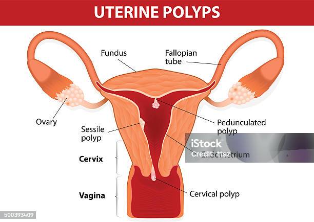 Endometrial Polyp Ou Polyp Utérine Vecteurs libres de droits et plus d'images vectorielles de Polype - Tumeur - Polype - Tumeur, Utérus, Endomètre