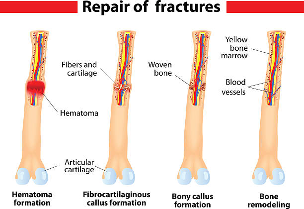 ilustraciones, imágenes clip art, dibujos animados e iconos de stock de proceso de cicatrización defectuosa de fracturas óseas - sistema de havers