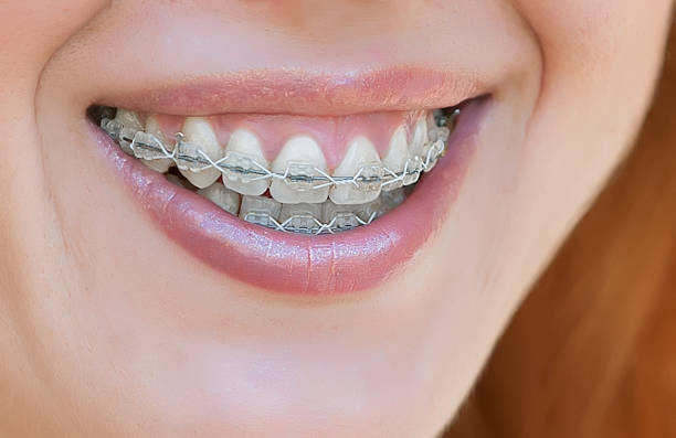 istock Young Adult Teeth with braces 500537995