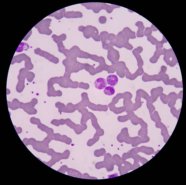 istock Blood smear form sepsis.septicemia can progress to sepsis. 500563958