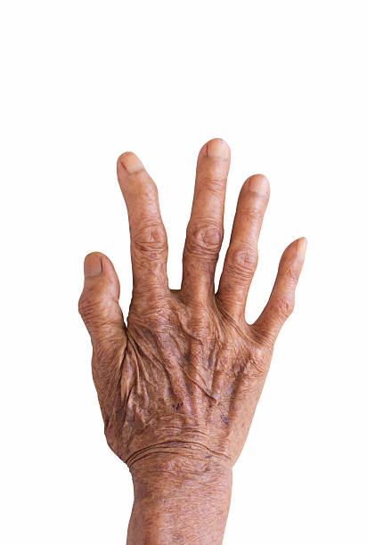 right hand of a leprosy isolated on white background right hand of a leprosy isolated on white background leprosy stock pictures, royalty-free photos & images