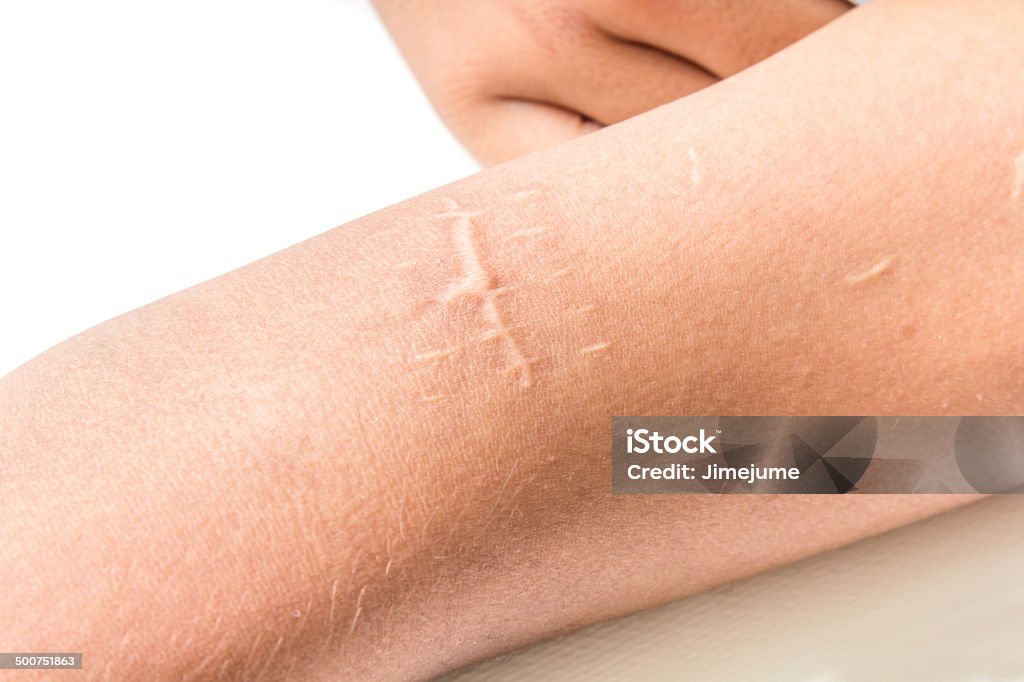 Scar of cutdown Scar of cutdown for IVs and medicine on arm. Scar Stock Photo
