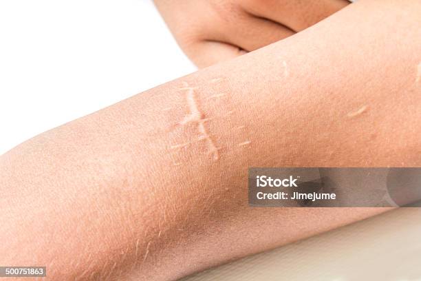 Scar Of Cutdown Stock Photo - Download Image Now - Scar, Healthcare And Medicine, Horizontal