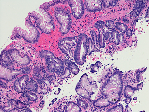Microscopic photo of a professionally prepared slide demonstrating intestinal metaplasia of the esophagus. Barrett's esophagus caused by gastroesophageal reflux disease. Chronic esophagitis.