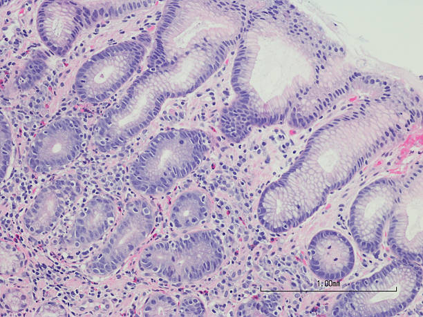 helicobacter pylori gastritis en el estómago, reactiva epitelio biopsia - pylori fotografías e imágenes de stock