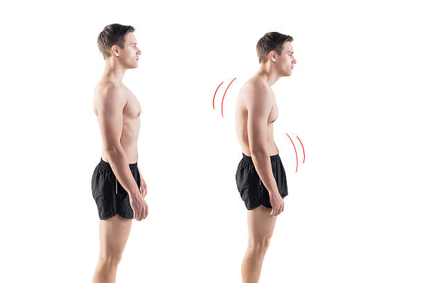 Man with impaired posture position defect scoliosis and ideal bearing stock photo