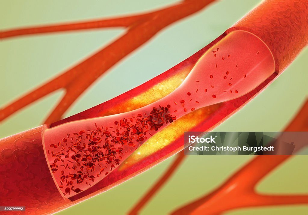 precipitate and narrowing of the blood vessels - arteriosclerosis Blood Clot Stock Photo