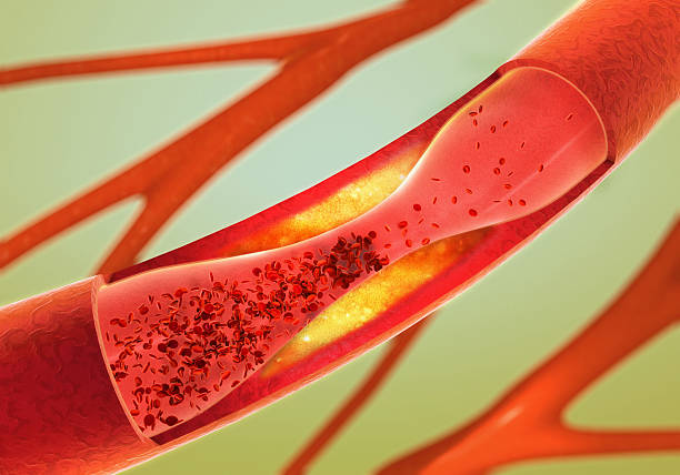 precipitate and narrowing of the blood vessels - arteriosclerosis precipitate and narrowing of the blood vessels - arteriosclerosis cholesterol photos stock pictures, royalty-free photos & images