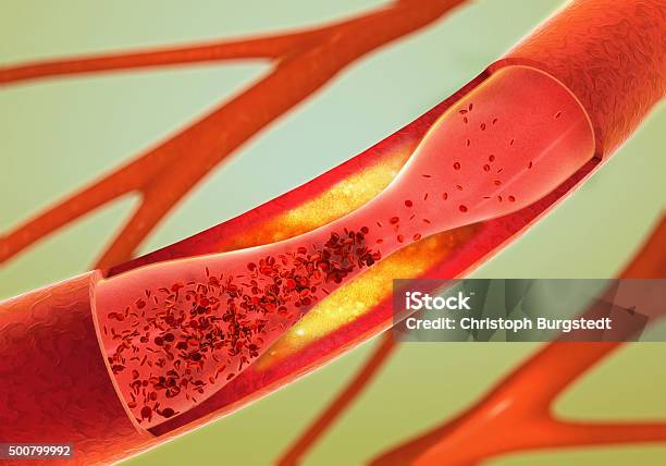 Precipitate And Narrowing Of The Blood Vessels Arteriosclerosis Stock Photo - Download Image Now