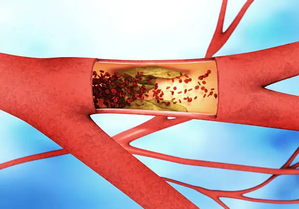 precipitate and narrowing of the blood vessels - arteriosclerosis