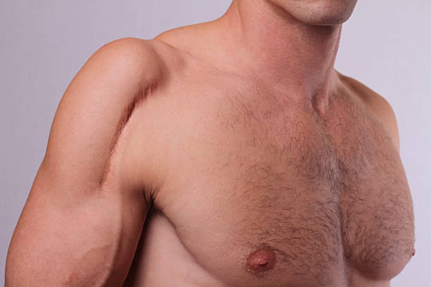 istock Man  man with scar on his  hand shoulder. 500833824