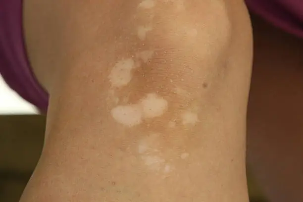 Photo of Knee with vitiligo skin condition