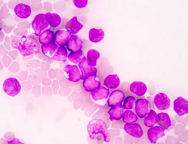 Medical science background showing blast cells(AML) blood smear is often used as a follow-up test to abnormal results on a complete blood count (CBC) to evaluate the different types of blood cells.Medical science background showing blast cells(AML) cytoplasm photos stock pictures, royalty-free photos & images