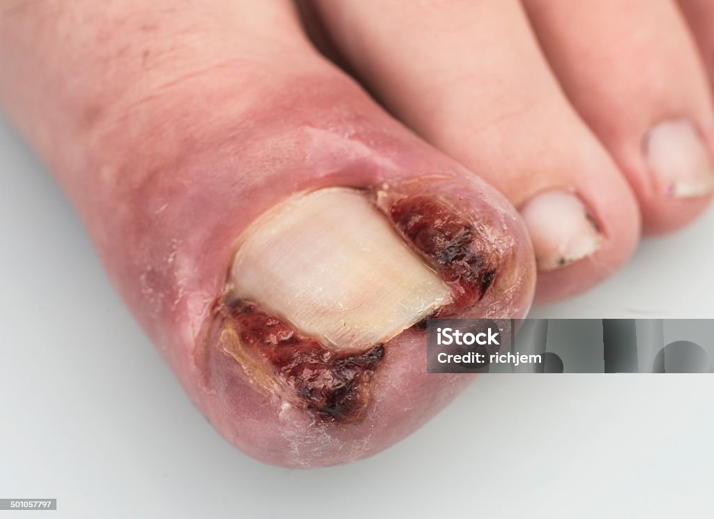 ingrowing toenail an ingrowing toe nail on the big toe of a young girl Blood Stock Photo