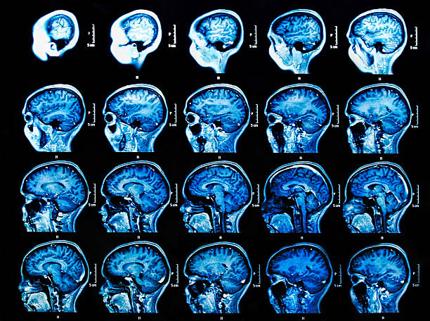 mri brain scan - brain scan' bildbanksfoton och bilder