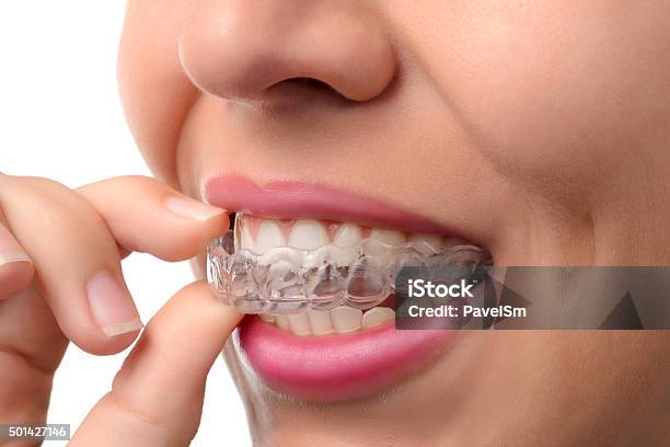 Frau Mit Orthodontic Silikontrainer Stockfoto und mehr Bilder von Zahnschiene - Zahnschiene, Zahnarztausrüstung, Zahnpflege