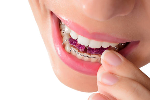 Woman wearing orthodontic removable brac Woman wearing orthodontic removable brace. Invisible braces detachable stock pictures, royalty-free photos & images