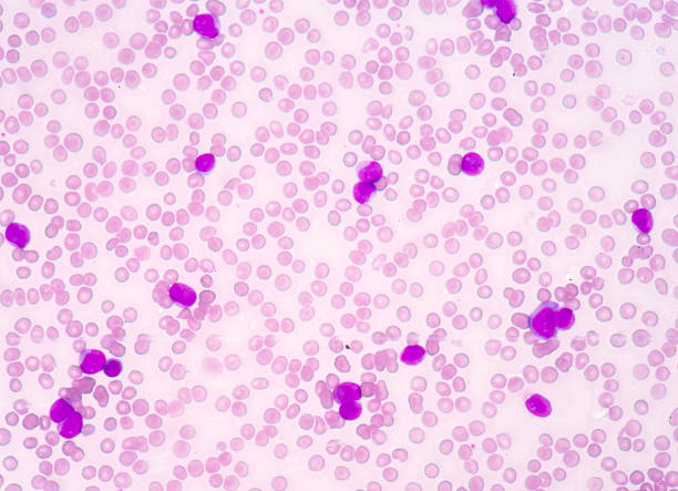 istock Medical science background showing blast cells(AML) 501533650
