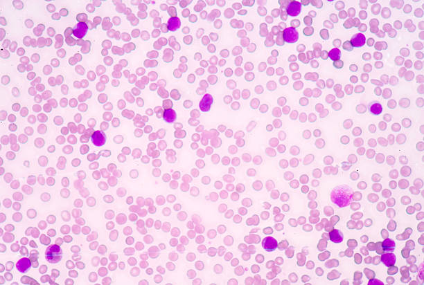 istock Medical science background showing blast cells(AML) 501533940