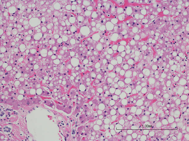 Macrovesicular hepatic steatosis of the liver (fatty liver disease), Microscopic photo of a professionally prepared slide demonstrating macrovesicular steatosis of the liver (fatty liver disease), hepatic steatosis, metabolic syndrome.  Can be ssociated with nonalcoholic fatty liver disease (NAFLD) or Alcoholic Liver Disease (ALD).  H&E stain. light micrograph stock pictures, royalty-free photos & images