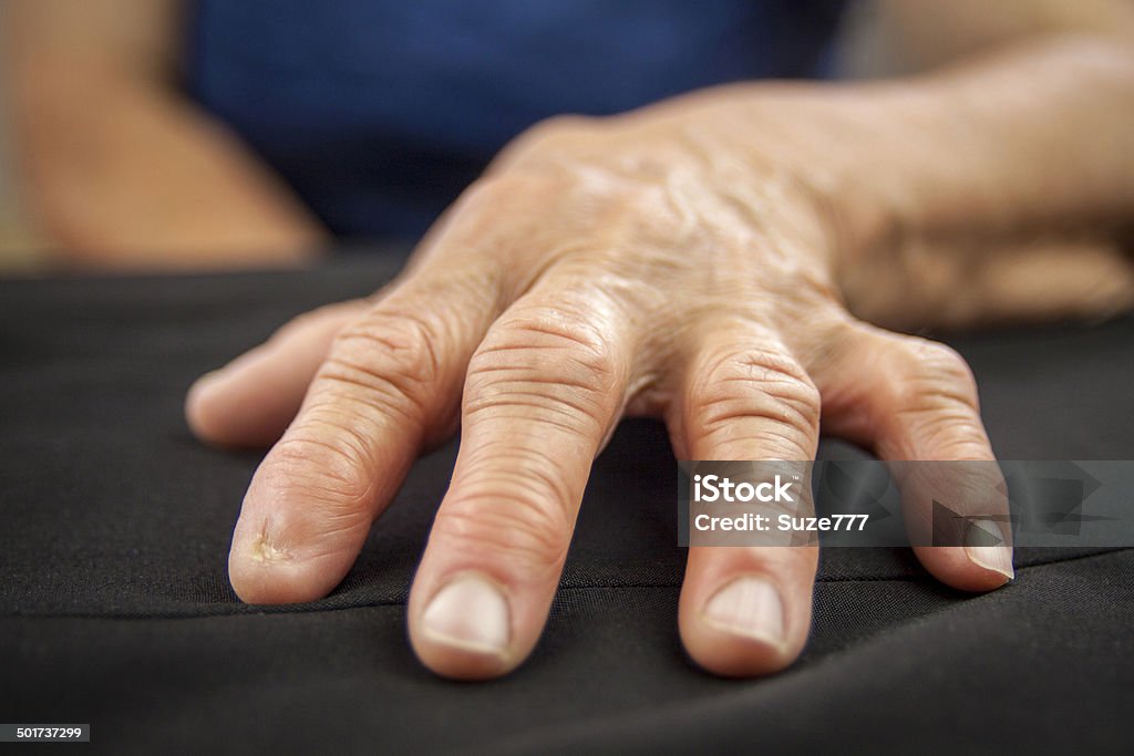 Rheumatoid arthritis hand Adult Stock Photo