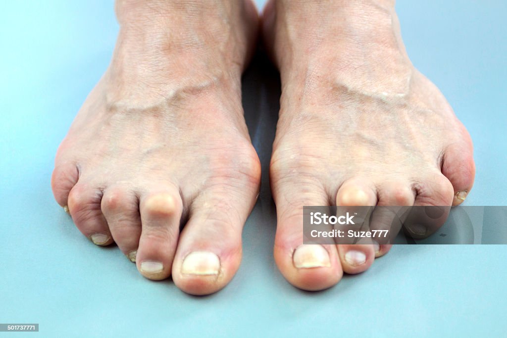 Feet Of Woman Deformed From Rheumatoid Arthritis Feet Of Woman Deformed From Rheumatoid Arthritis. Macro Rheumatoid Arthritis Stock Photo