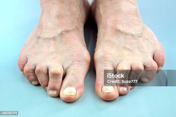 Feet Of Woman Deformed From Rheumatoid Arthritis Stock Photo - Download Image Now - Rheumatoid Arthritis, Adult, Bizarre