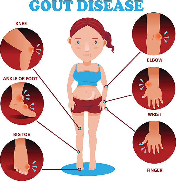 illustrations, cliparts, dessins animés et icônes de symptômes gout - big toe