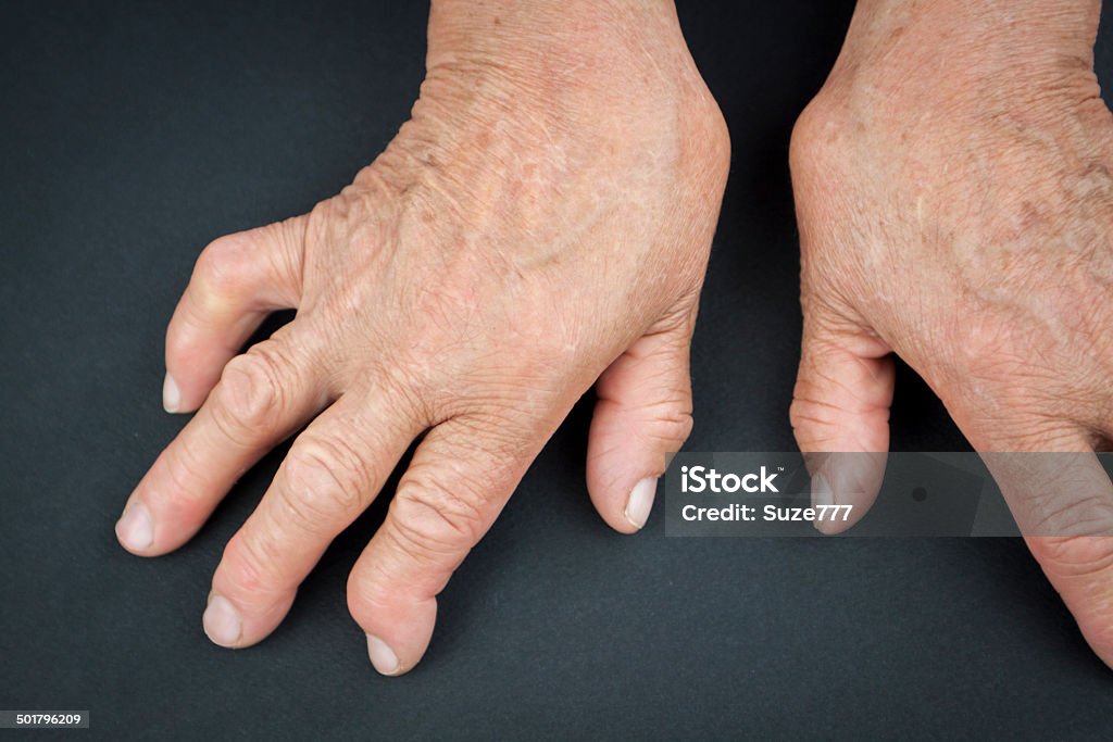 Rheumatoid arthritis hands Rheumatoid arthritis hands. MacroRheumatoid arthritis hands. Macro Adult Stock Photo