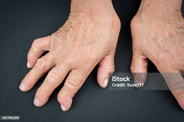 Rheumatoid Arthritis Hands Stock Photo - Download Image Now - Adult, Bizarre, Close-up