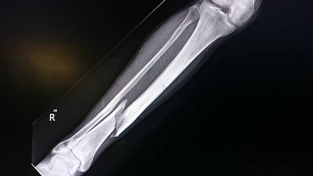 Spiral Fracture Spiral fracture of the tibia broken leg stock pictures, royalty-free photos & images