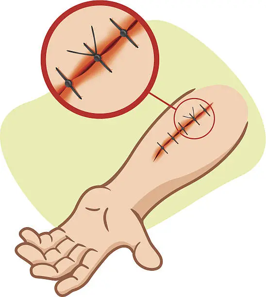 First Aid suture injury. Illustration of a receiving first aid, injury or cut and sutured arm. Wound Carecartoon stock illustrations