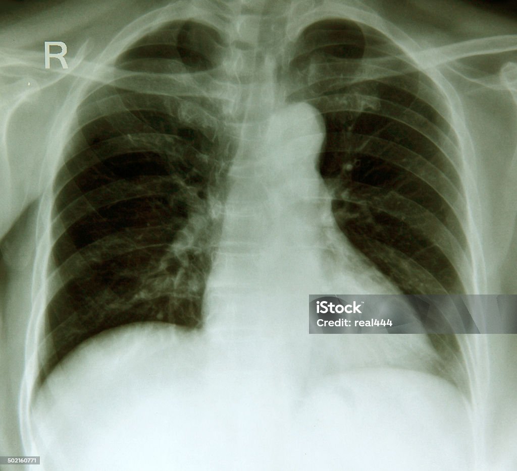 X-ray image de la poitrine. - Photo de Cage thoracique libre de droits